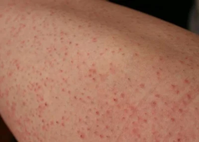 ingrown hairs ingrown hairs